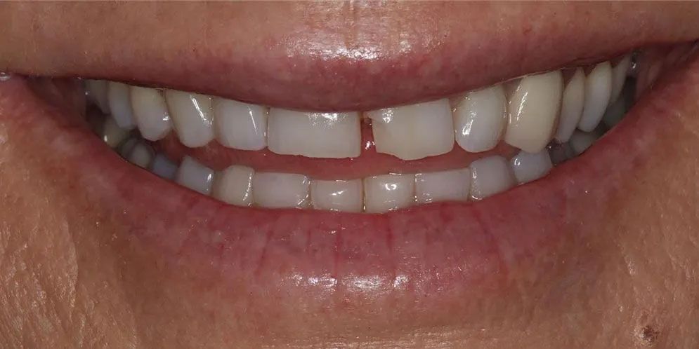 A close up of a woman 's smile with a missing tooth.