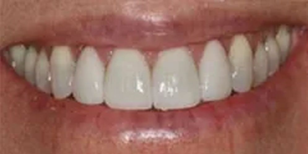 A close up of a person 's smile with white teeth.