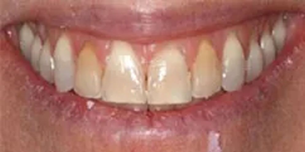 A close up of a person 's teeth with a smile on their face.