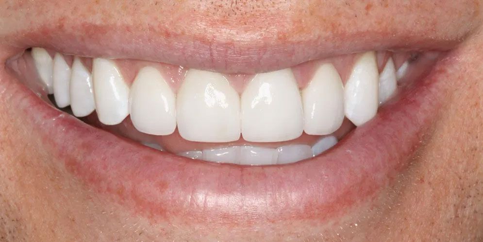 A close up of a man 's smile with white teeth.