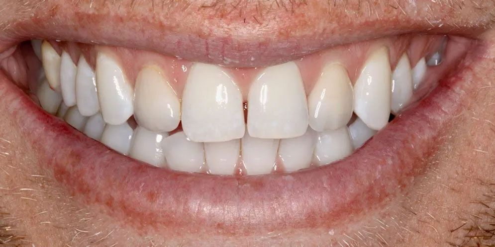 A close up of a man 's smile with white teeth.