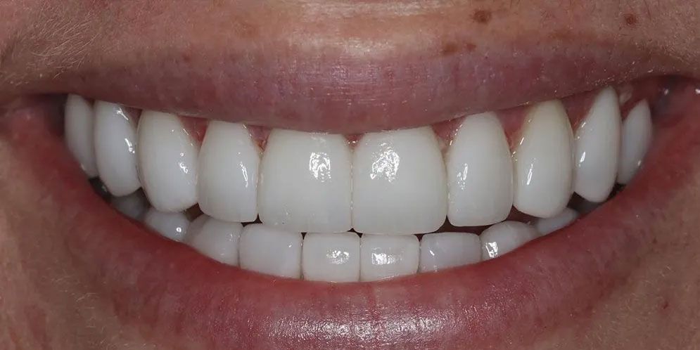 A close up of a woman 's smile with white teeth.