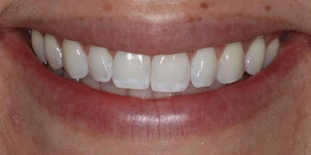 A close up of a woman 's smile with white teeth.