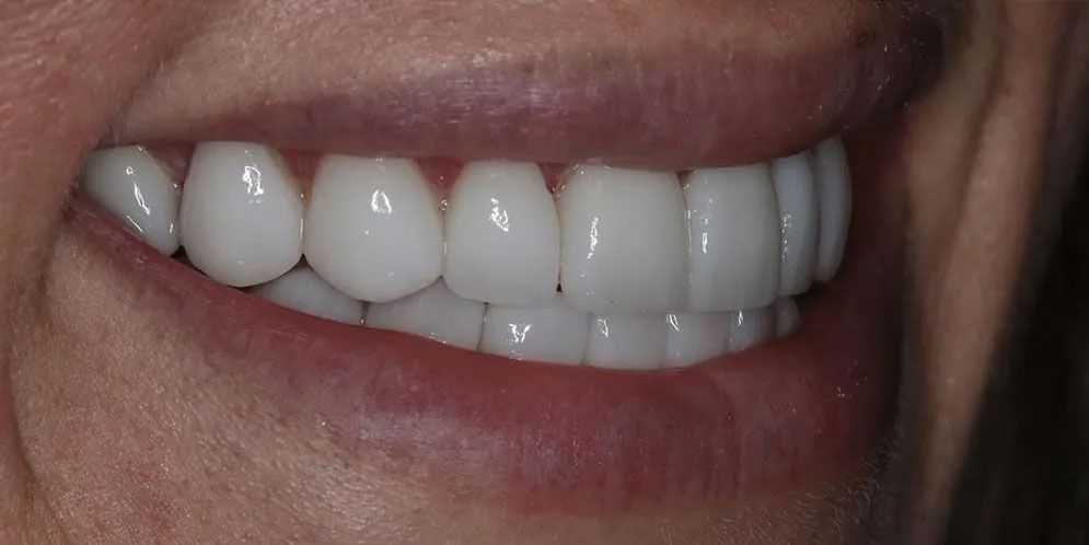 A close up of a woman 's smile with white teeth.