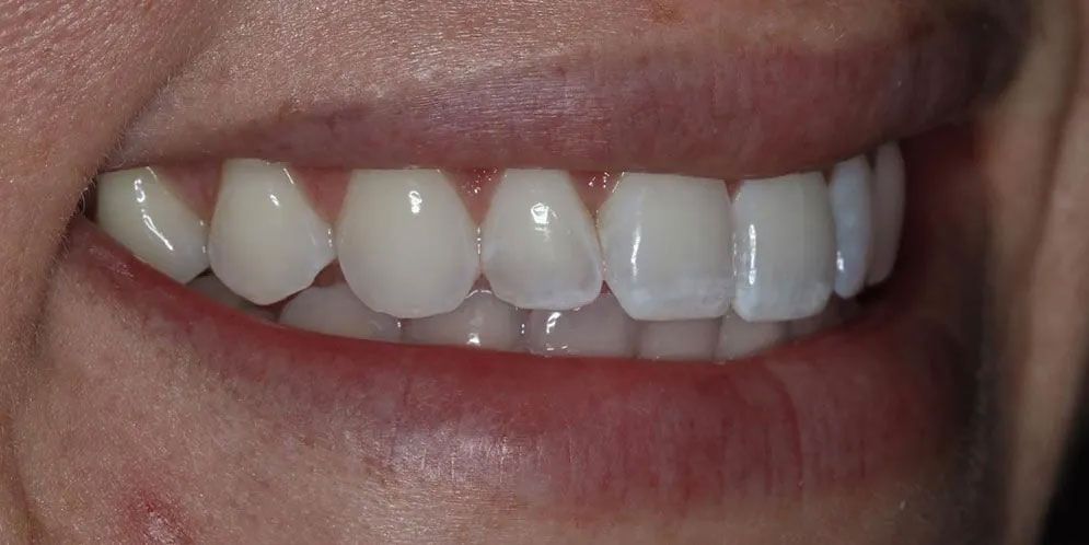 A close up of a woman 's smile with white teeth.