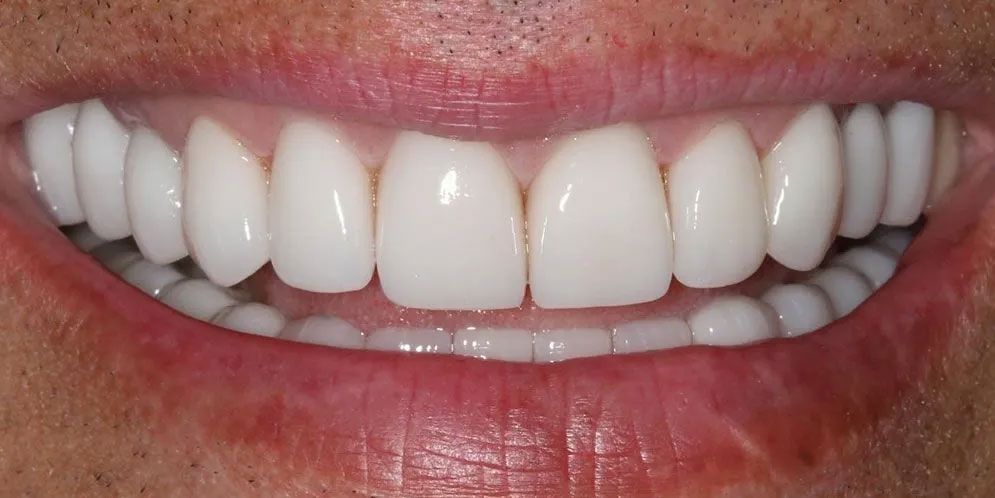 A close up of a person 's smile with white teeth.