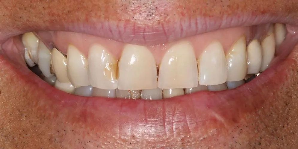 A close up of a man 's teeth with a smile on his face.