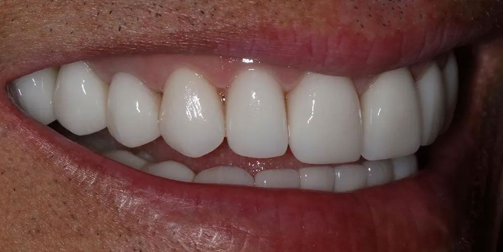A close up of a person 's smile with white teeth.