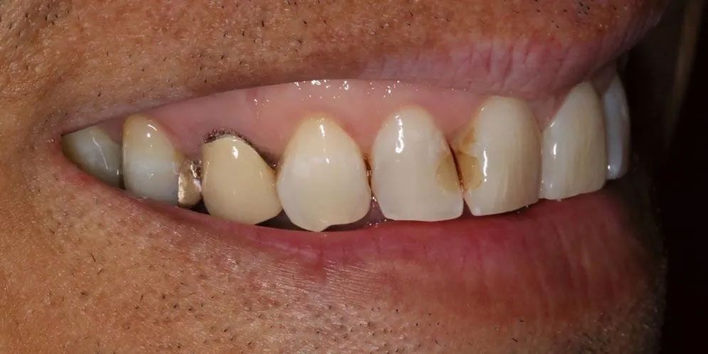 A close up of a man 's teeth with a missing tooth.