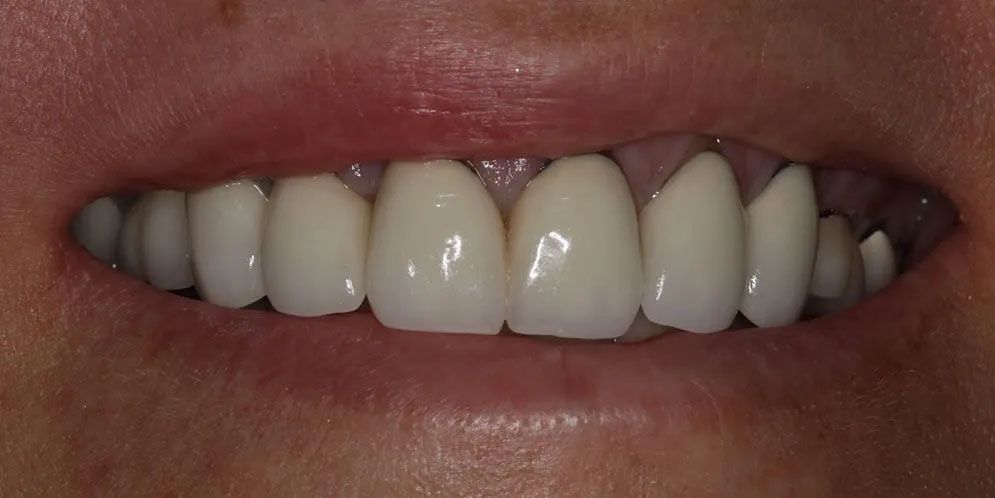 A close up of a woman 's smile with white teeth.