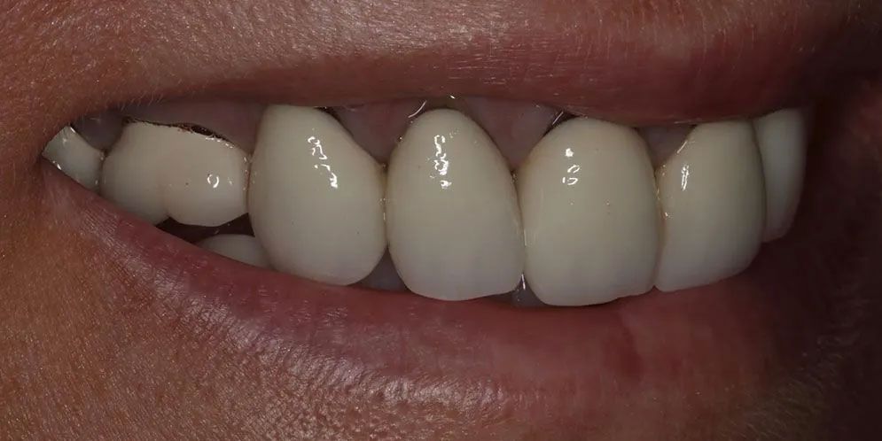 A close up of a person 's teeth with a broken tooth.