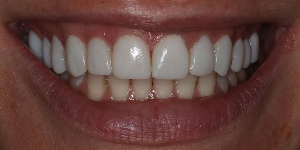 A close up of a woman 's smile with white teeth.