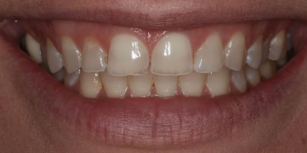 A close up of a person 's teeth with white teeth.