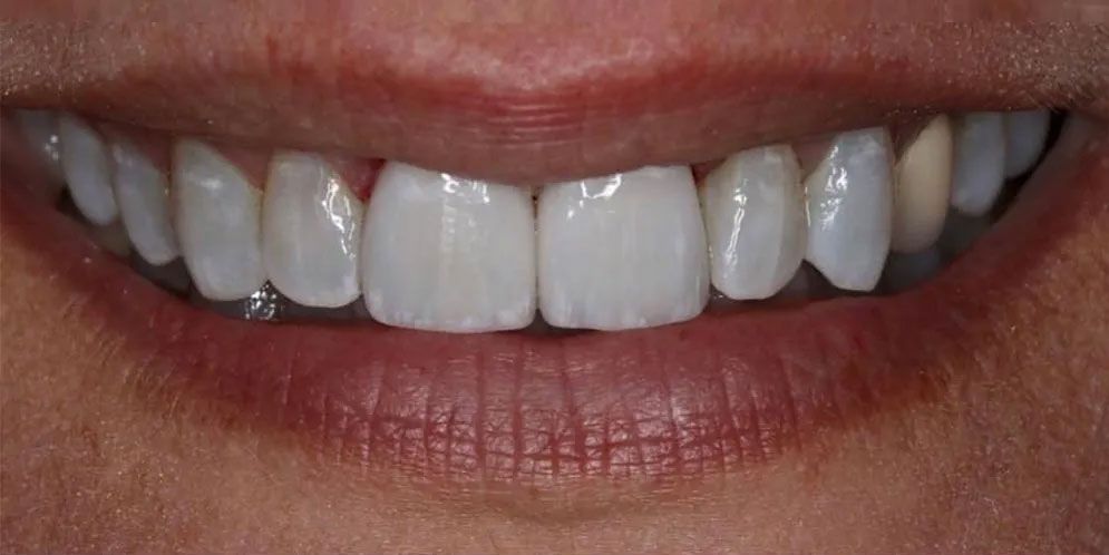 A close up of a woman 's smile with white teeth.
