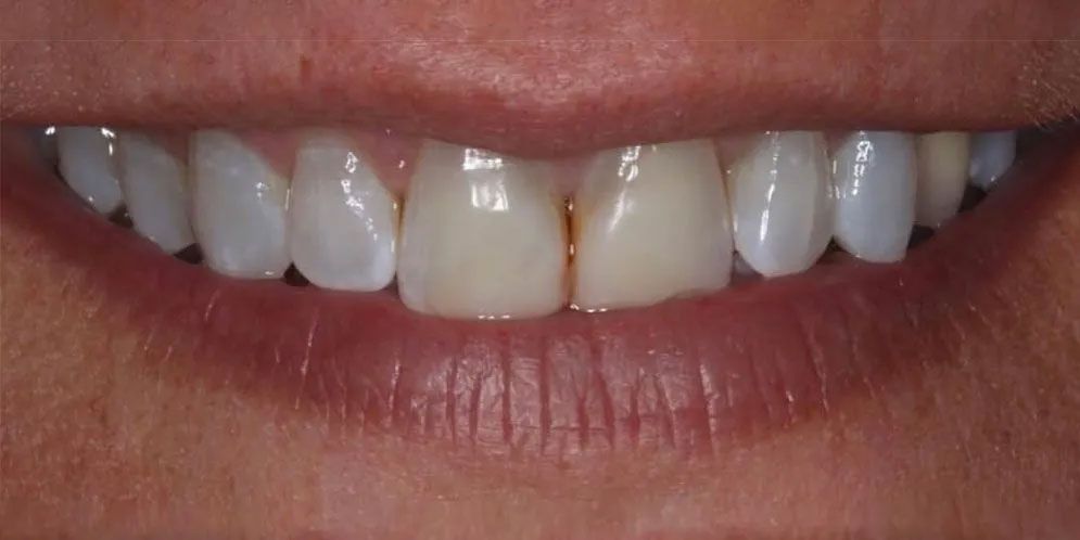 A close up of a person 's smile with white teeth.