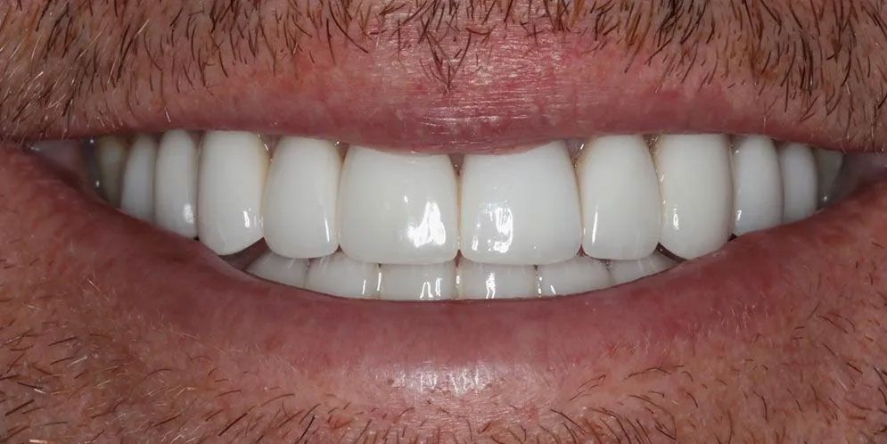 A close up of a man 's smile with white teeth.
