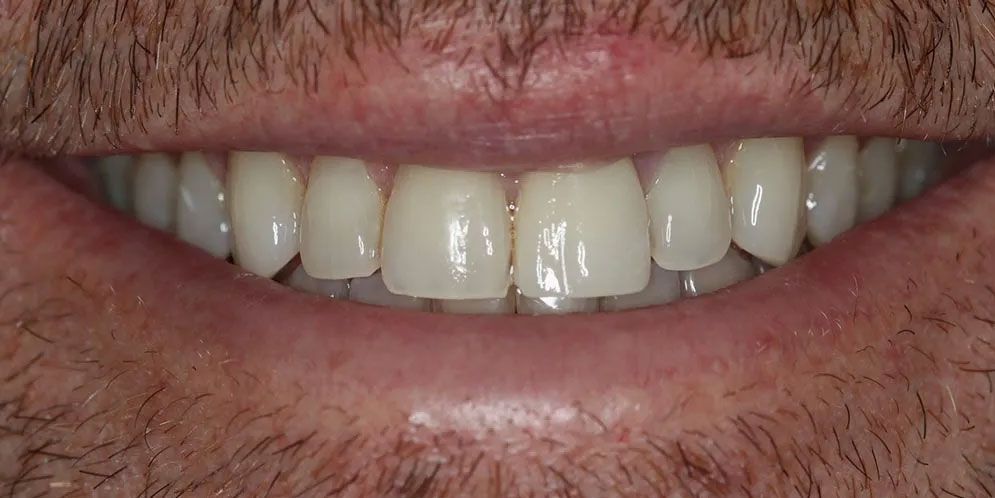 A close up of a man 's teeth with a beard.