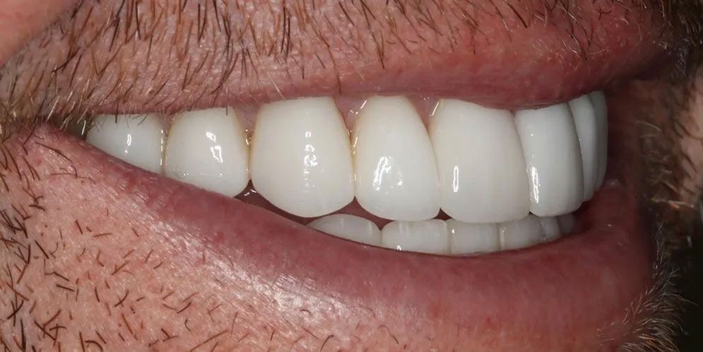 A close up of a man 's mouth with white teeth.