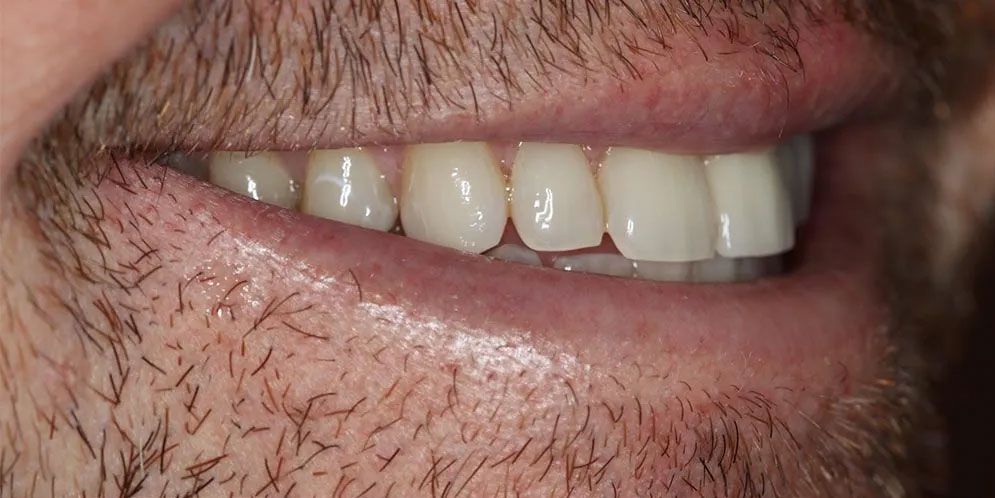 A close up of a man 's mouth with white teeth and a beard.
