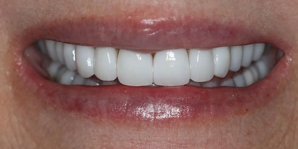 A close up of a woman 's mouth with white teeth.