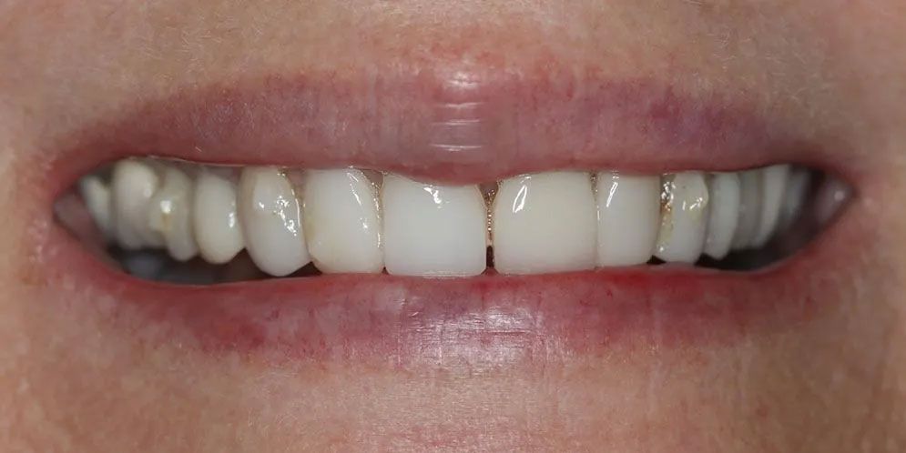 A close up of a person 's mouth with white teeth.