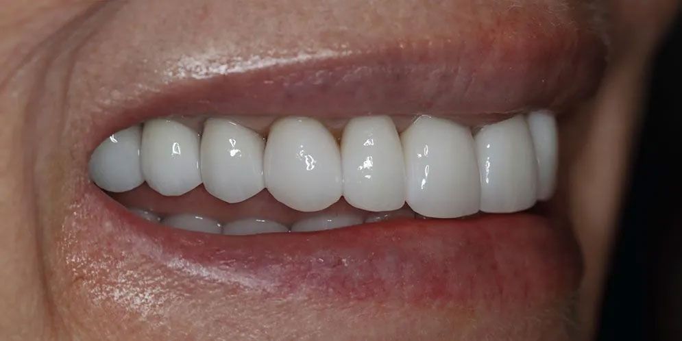 A close up of a woman 's mouth with white teeth.