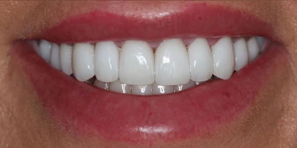 A close up of a woman 's smile with white teeth and red lips.