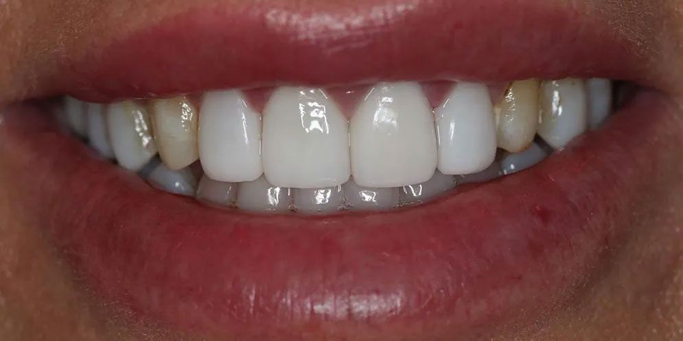 A close up of a person 's mouth with white teeth.