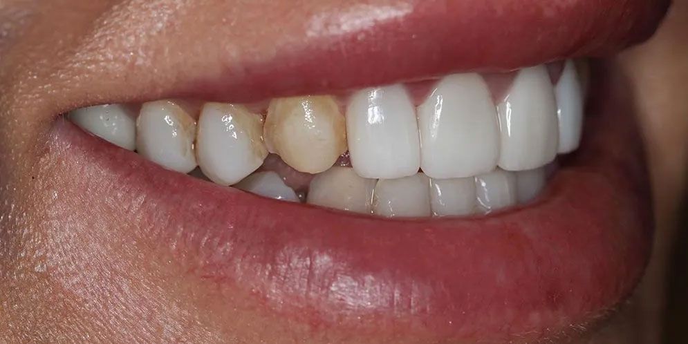 A close up of a woman 's mouth with white teeth.