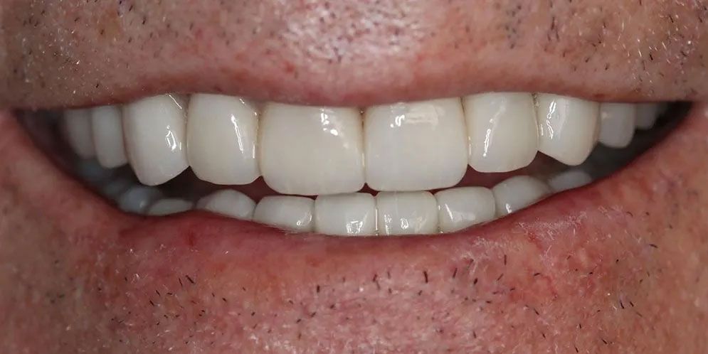 A close up of a man 's smile with white teeth.