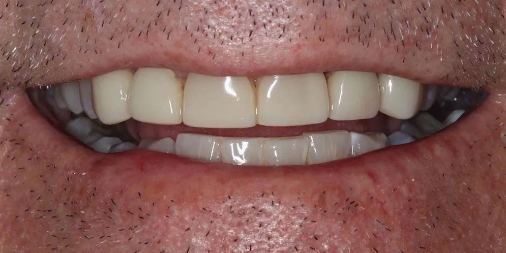 A close up of a man 's mouth with white teeth.