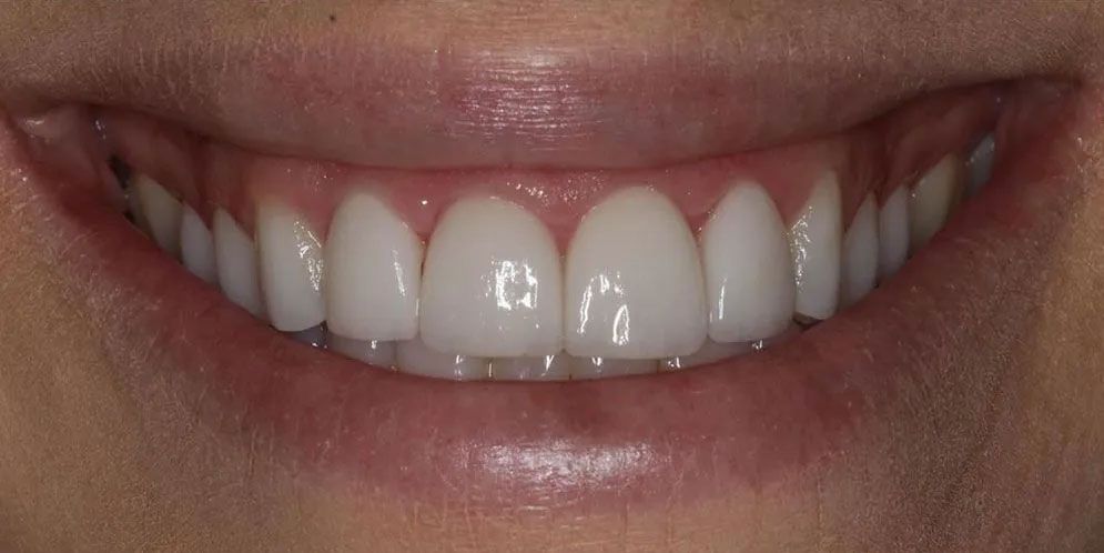 A close up of a woman 's smile with white teeth.