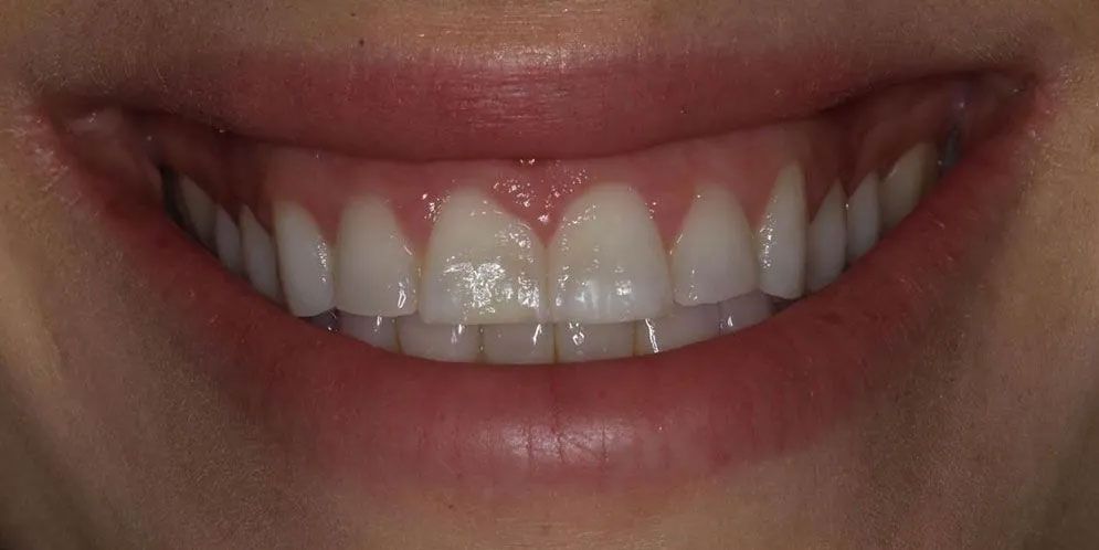 A close up of a person 's smile with white teeth.