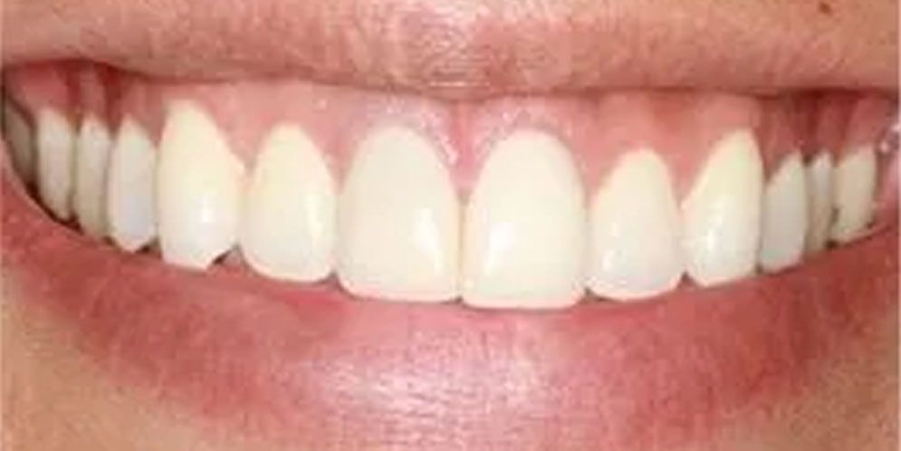 A close up of a person 's teeth with white teeth.