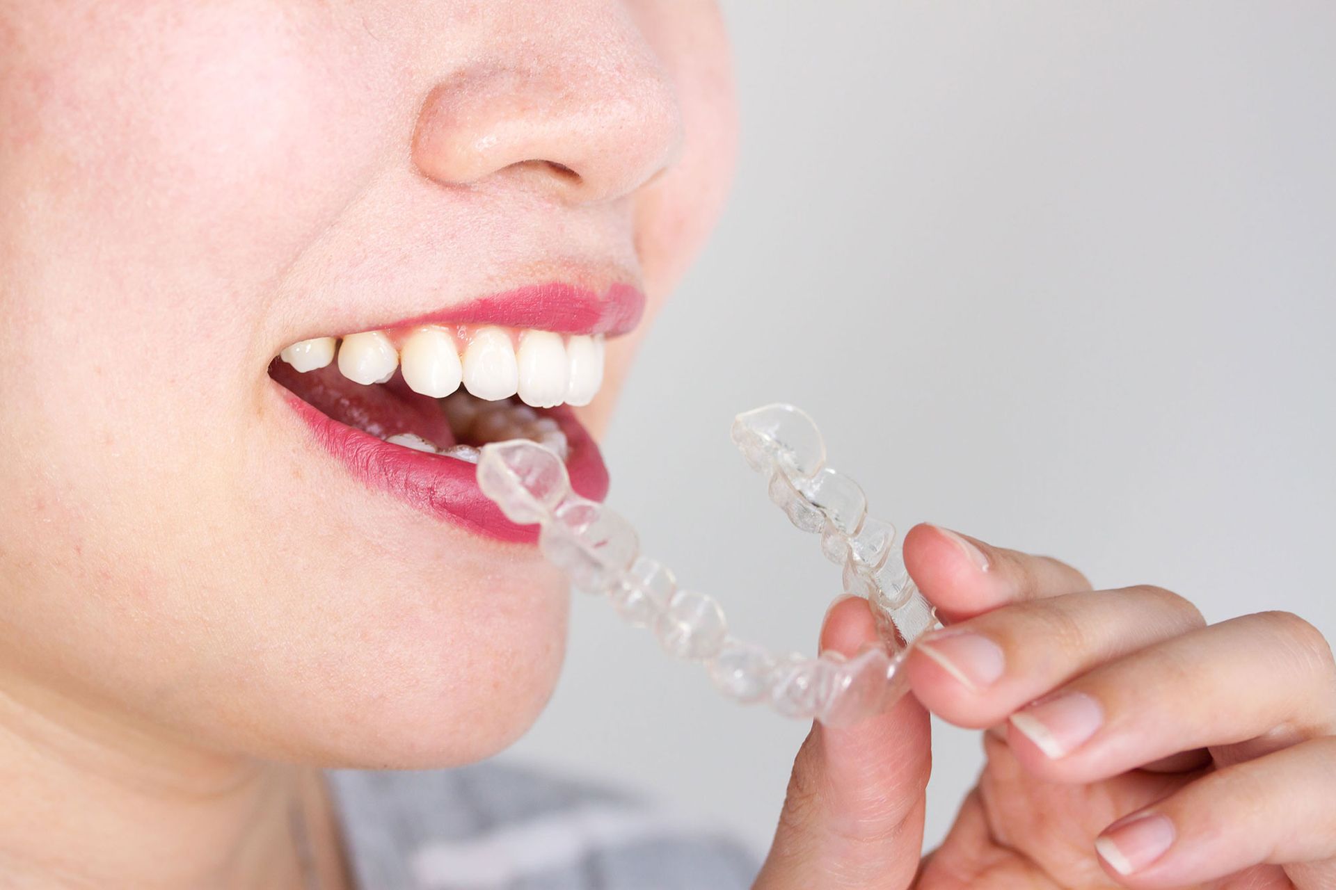 Woman smiling, inserting clear aligner into her mouth.