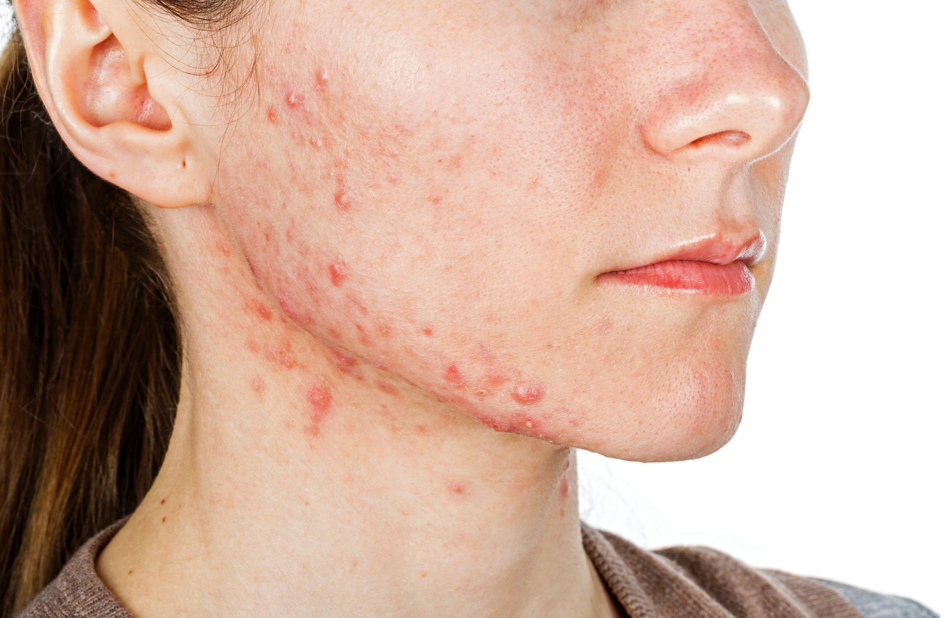 skincare for radiation treatment