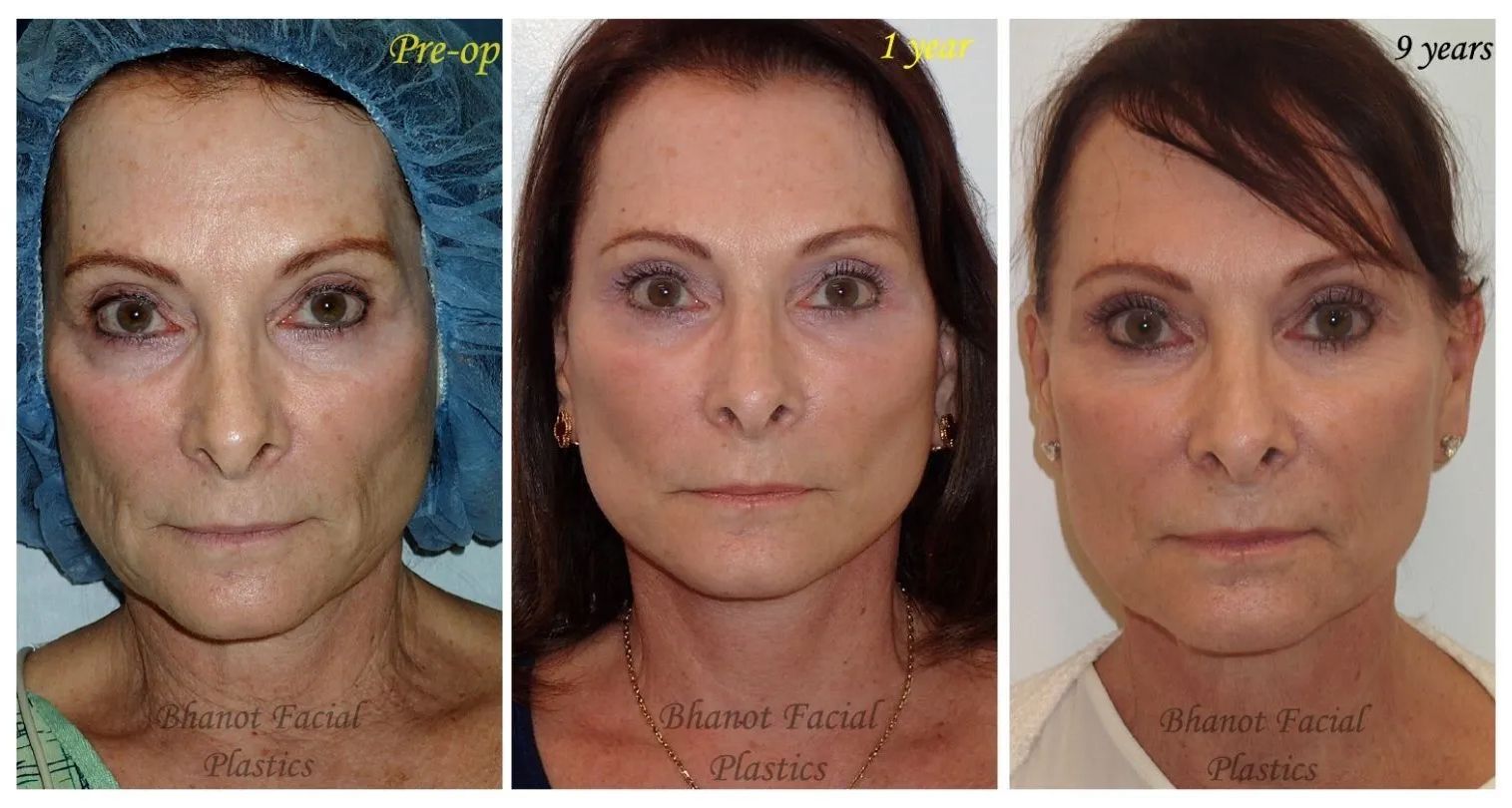 1-9 years of Pre and Post Deep Plane Facelift Lower Blepharoplasty