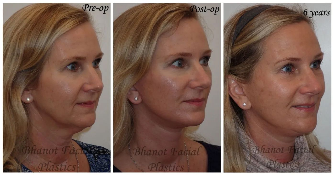 Pre and Post Result for 6 Years of Deep Plane Facelift Lower Blepharoplasty