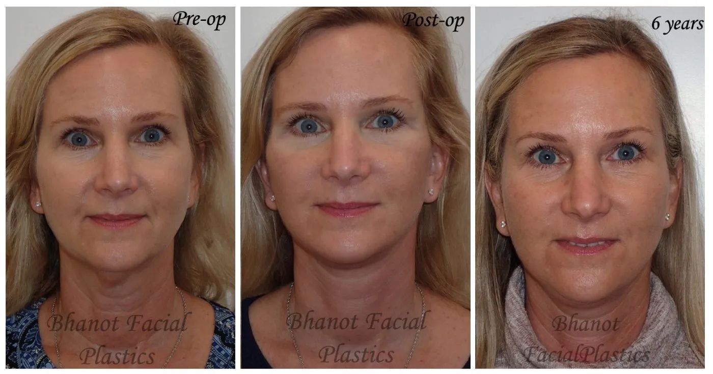 Results for 6 Years of Deep Plane Facelift Lower Blepharoplasty