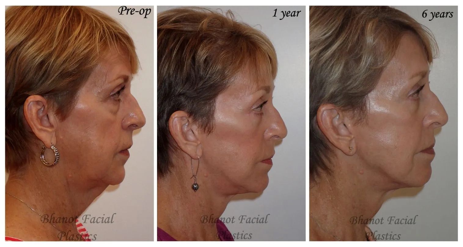 1-6 Years of Deep Plane Facelift Browlift Blepharoplasty Results