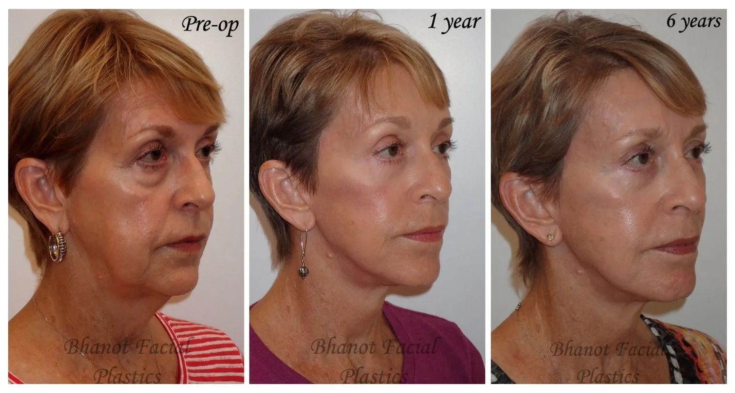 1-6 Years of Deep Plane Facelift Browlift Blepharoplasty Before and After Results