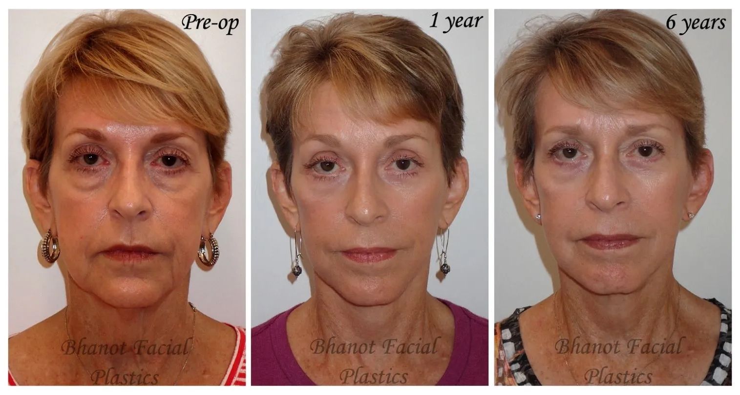 1-6 Years of Deep Plane Facelift Browlift Blepharoplasty