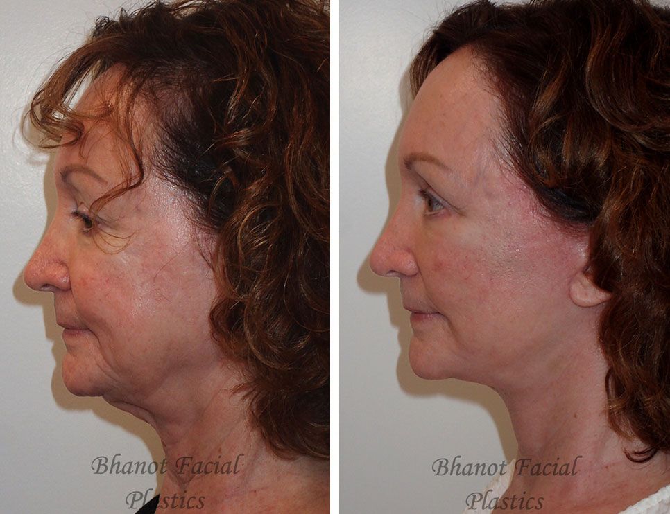 Pre and Post Deep Plane Facelift Lower Blepharoplasty