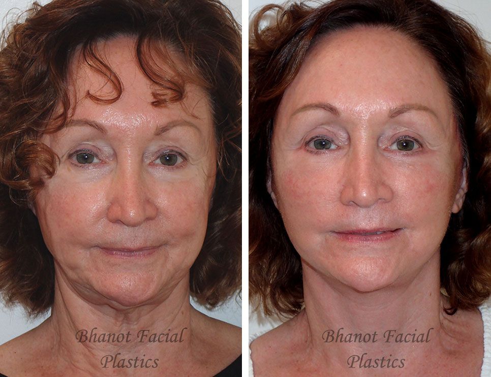 Pre and Post Deep Plane Facelift