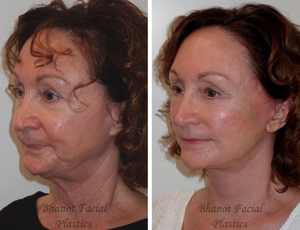 A before and after photo of a woman's face