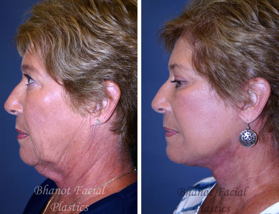 Pre and Post Deep Plane Facelift Upper Lower Blepharoplasty