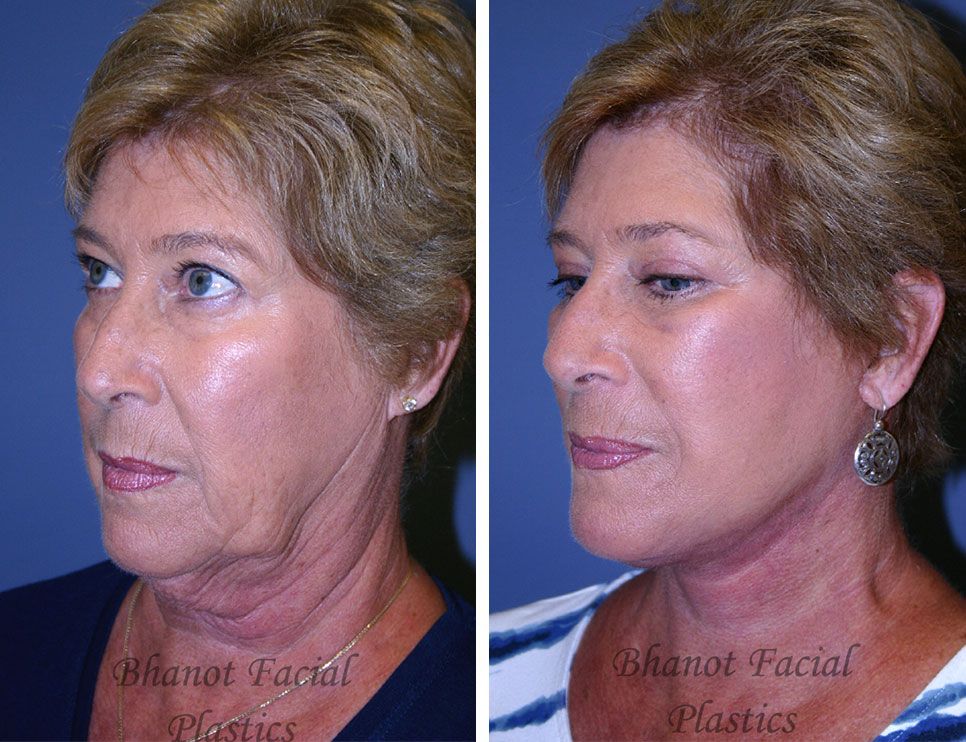 A before and after photo of a woman's face and neck