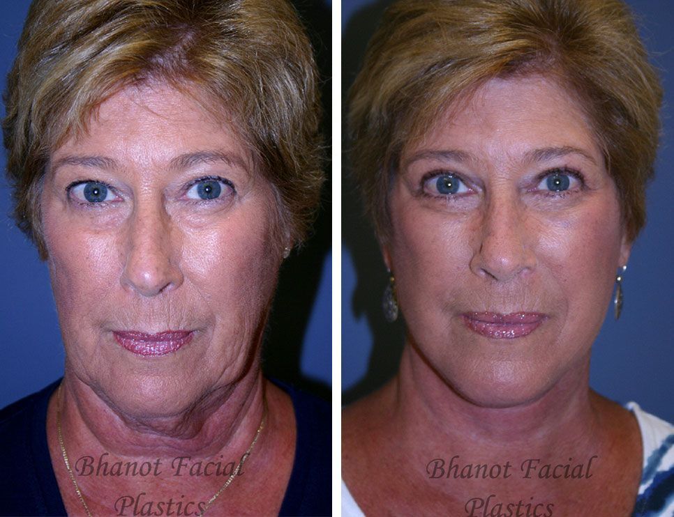 A before-and-after photo of a woman's face and neck.