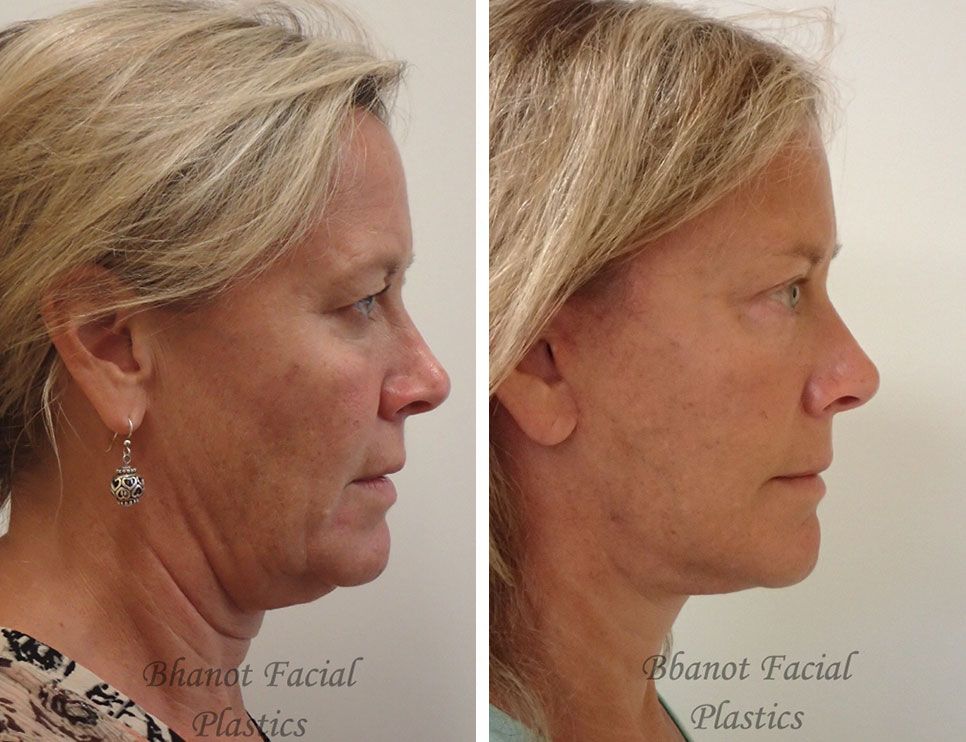 Pre and Post Deep Plane Facelift Browlift Upper Lower Blepharoplasty
