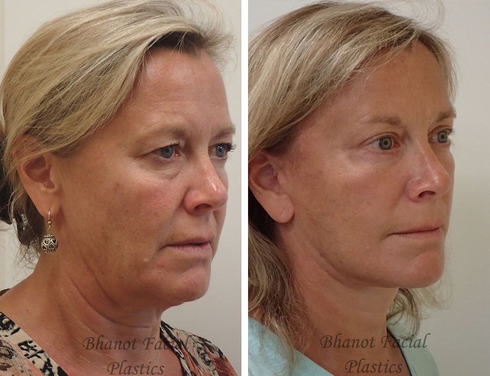 Pre and Post Deep Plane Browlift Upper Lower Blepharoplasty Facelift